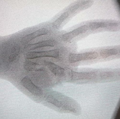Revascularization of multiple level amputation of fingers.